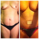 Before picture next to my day two post op picture.  I was SOOO proud of how low my doc. got the scar that I wanted to show her a picture at one my week post op visit.