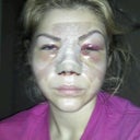 3 days post op.  depression kicking in.