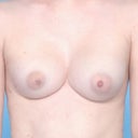 Before Surgery