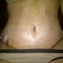 13 days after surgery, feeling better and better!