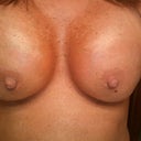 omg this is a great picture of post op 15 days I lover the ultra high Profile everyone should do this forget going a zillion cc's bigger go ultra high with a huge projection. amazing and beautiful so many compliments... really women think about it. Ahh they are shaping slowly as they drop. slow process good luck each day it's a roller coaster ride w/ boobies...Still looking like Frankenboobies