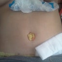 1 day post op