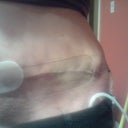 20 days post op. Tried Derma blend on a little section of scar and the scar is barely noticeable!