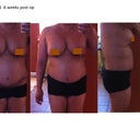 6 weeks post op