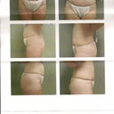 Dr's 4 wk postop pics