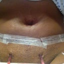 3 days post op