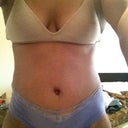 11 day post op