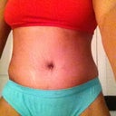 7 day po, scar hidden by underwear