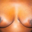frontal view with zoom on scars 6 weeks post op