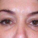 Day 11.  Can you see the deflation.  The exact same circles around my tear trough area that I went in for are back!