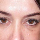 Day 12 most bruising is gone and this is a different angle of my eyes.  The tear troughs look as sunken in as day 11.