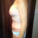 20 days post, swollen at days end, boobs not quite there yet.