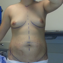 marke-up before surgery