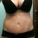 3weeks. I have the silicone strip on BB.Spots on tummy is where blisters were after TT.