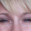 Photo #1 (a few days after DYSPORT)I am honestly not exaggerating .... this is what my eyes looked liked a fews days later when I tried to smile normally. My face was slightly swollen and the Dr. of course said he saw nothing :( I was experiencing massive headache, nausea, stomach pain and fatigue.