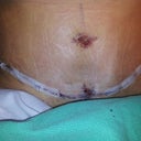 2 days post op. I Only have one drain. The wrinkles are from CG.