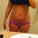 Preop picture 1
17 days before full TT