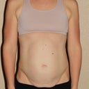 2 days before surgery