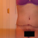 Post Op Day 57 (8 weeks & 1 day)