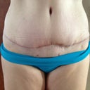 2 months PO - incision all healed up - you can see the scar is a little thicker where my hole was closed up 2 weeks ago