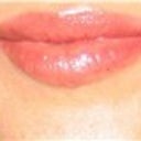 1 year post Restylane. Still working!