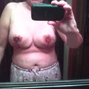 Post-op picture - Day 3