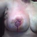 Lots of bruising