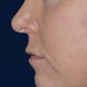 Chin Implant, Rhinoplasty And Signature Facelift