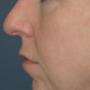 Chin Implant, Rhinoplasty And Signature Facelift