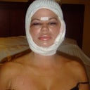 Heres the laugher....a few days after face
lift.......OH MY LORD!!!!Halloween costume for next yr!!