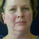 This was taken just before my 1st treatment in Dec 2009