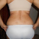 six weeks post op