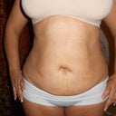 six weeks post op