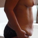 Side view - pre-op