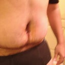 2 weeks Post op