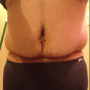 2 weeks Post op