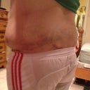 one Month Post OP :(