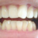 this was a photo taken before i started the invisalign process