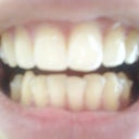 this is a photo taken before starting on my 10th aligner