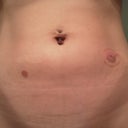 Day 3, AM Both burns