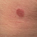 Day 3, AM, Close up of Burn 1