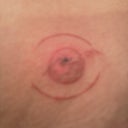 Day 3, AM, Close up of Burn 2