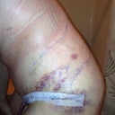 From the side. Swollen POD 4