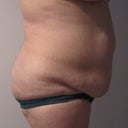 2 months before, right side