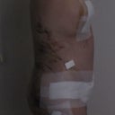 6 days PO, left view. It is morning time so swelling is minimal.