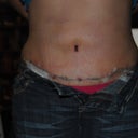 10 days after surgery