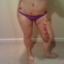 10 days post-op. Bad bruising.