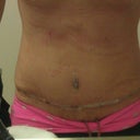 First brief look at the tummy, berry swollen and just took the cg off. I put it right back on and it helps significantly with the pain.