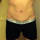 8 weeks post op - showing the incision