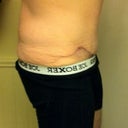 8 weeks post op - showing the incision